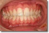 おめでとう！ムシ歯ゼロを達成したね。