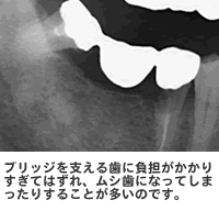 �u���b�W���x���鎕�ɕ��S��������