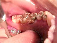 �v���[�N�̐��ߏo��