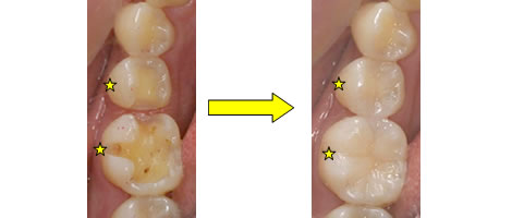 �n�C�u���b�h�Z���~�b�N�N���E���A�C�����[